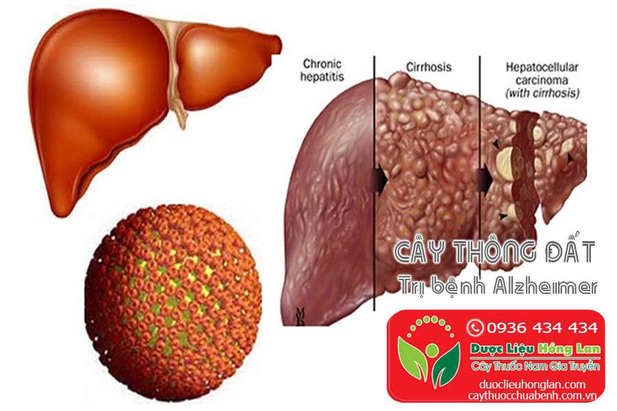 CAY-THONG-DAT-TRI-BENH-Alzheimer-CTY-DUOC-LIEU-HONG-LAN